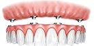 Full Arch Teeth Solutions