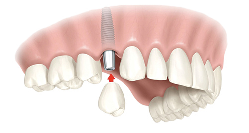 Single Dental Implants Chicago